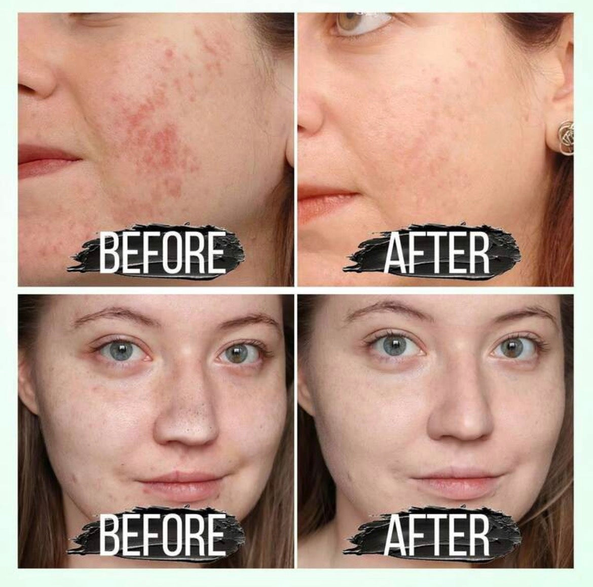 Blackhead remover mask